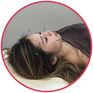 美容鍼 4,000円～（税抜き）